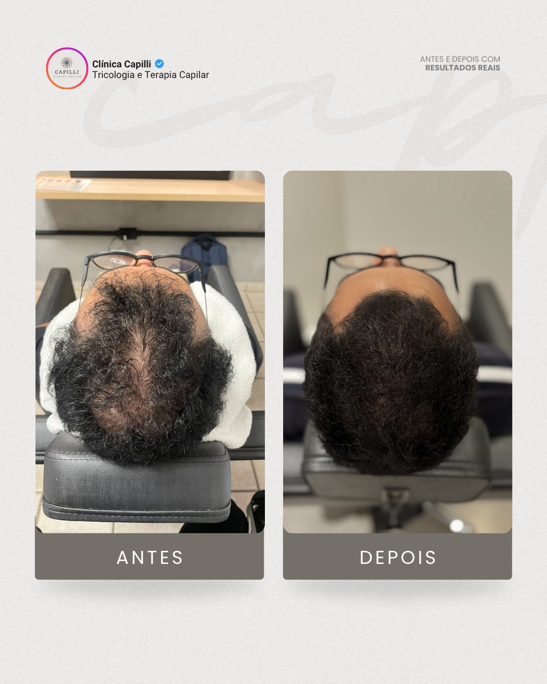 Resultado de tratamento capilar na Capilli - Alopecia androgenética